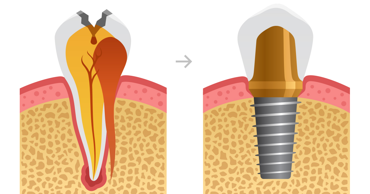 dca-blog_article-49_tooth-implant-types_1200x630