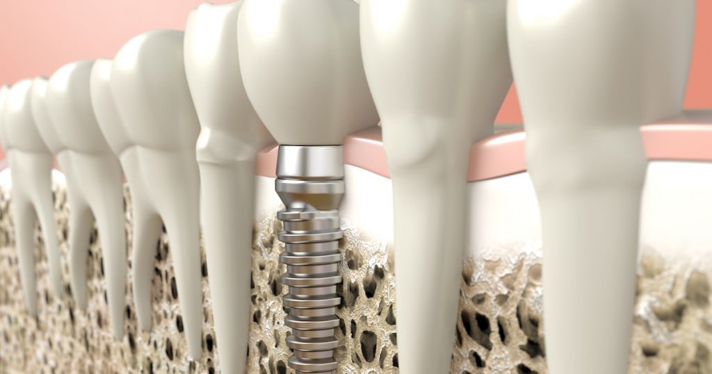 Very high resolution 3d rendering of a dental implant