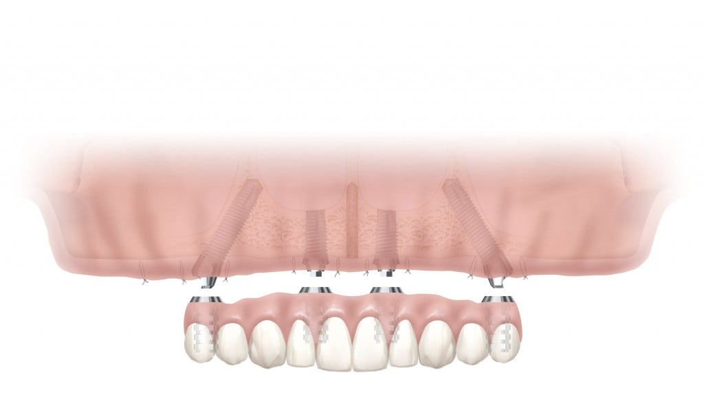 implant illustration front